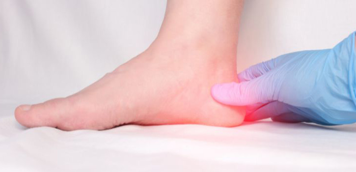 Prevención de la fascitis plantar